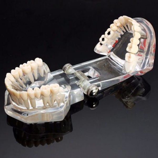 Dentcruise-Dental Study Model With Pathology And Half Implant-1