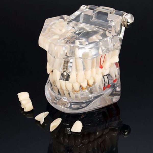 Dentcruise-Dental Study Model With Pathology And Half Implant-2