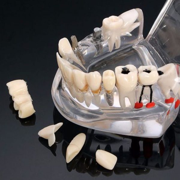 Dentcruise-Dental Study Model With Pathology And Half Implant-3